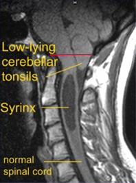 Chiari Abnormality (Pink Line)